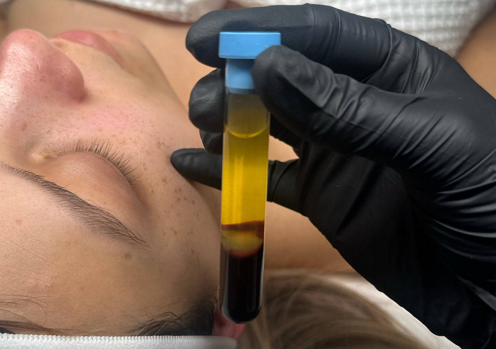 Platelet rich plasma / Plasma rico en plaquetas.