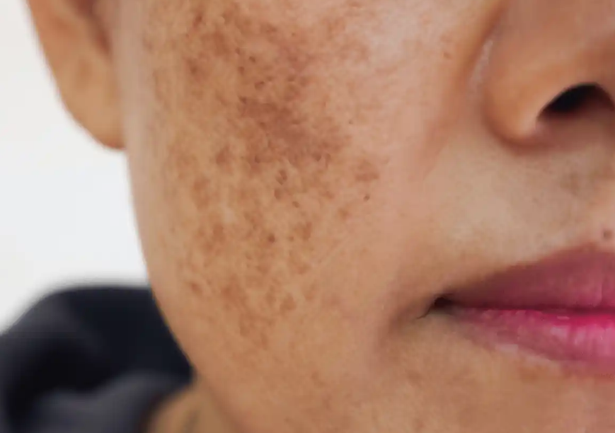 Melasma