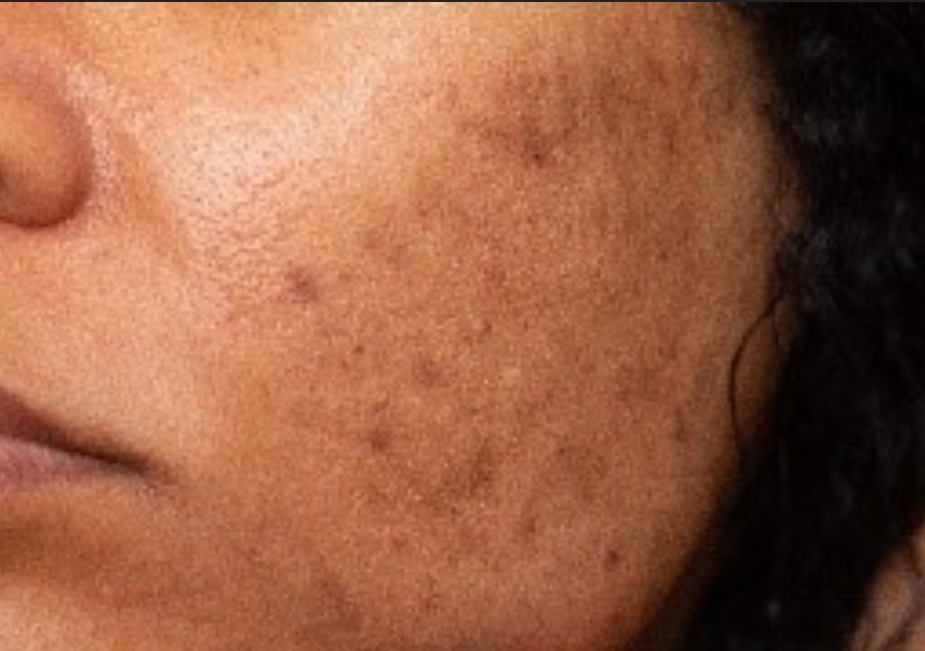 Hyperpigmentation / Hiperpigmentacion