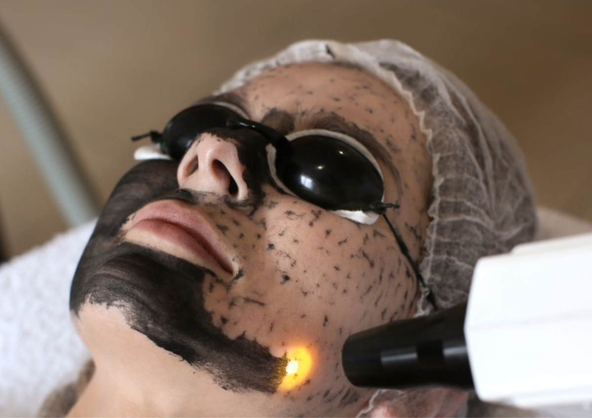 Hollywood Carbon Peel 