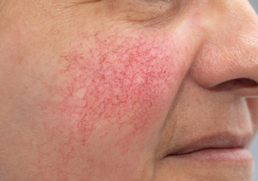 Rosacea