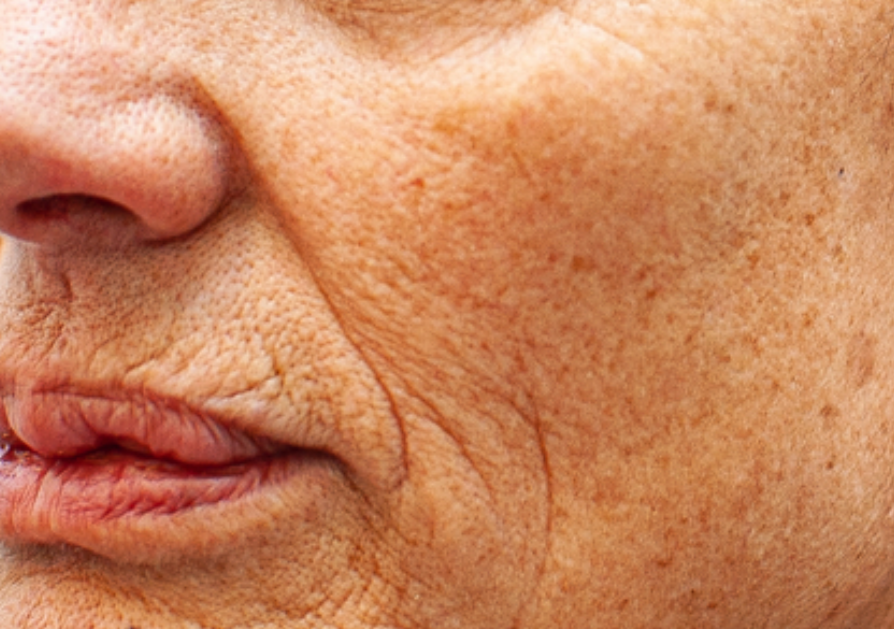 Photoaging / Fotoenvejecimiento