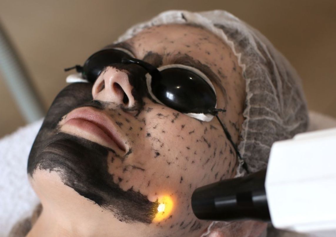 Hollywood Peel / Carbon Peel