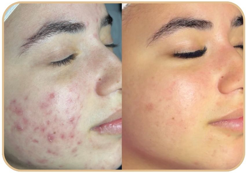 Acne Boot Camp / Limpieza Profunda + SKIN CARE ROUTINE