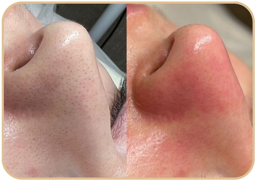 Limpieza Profunda Facial