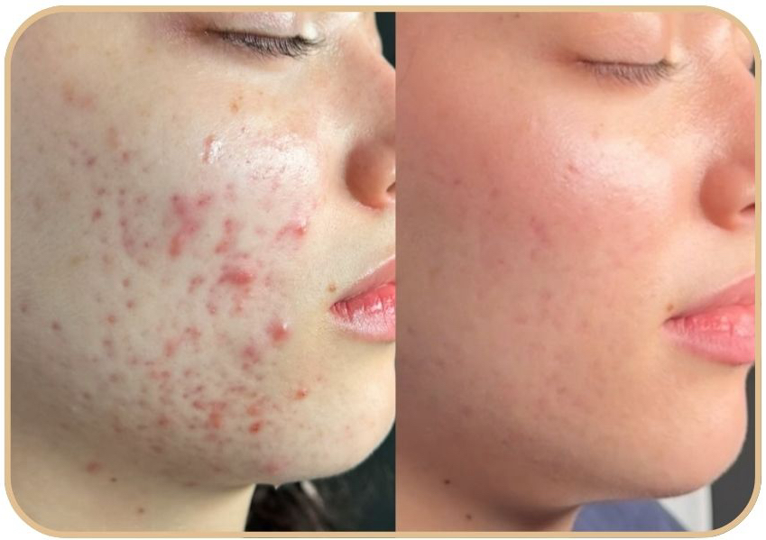 Acne Boot Camp / Limpieza Profunda + Exfoliacion Quimica + Terapia LED