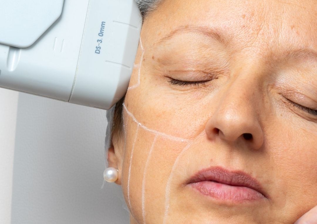 HIFU FACE - Full Face