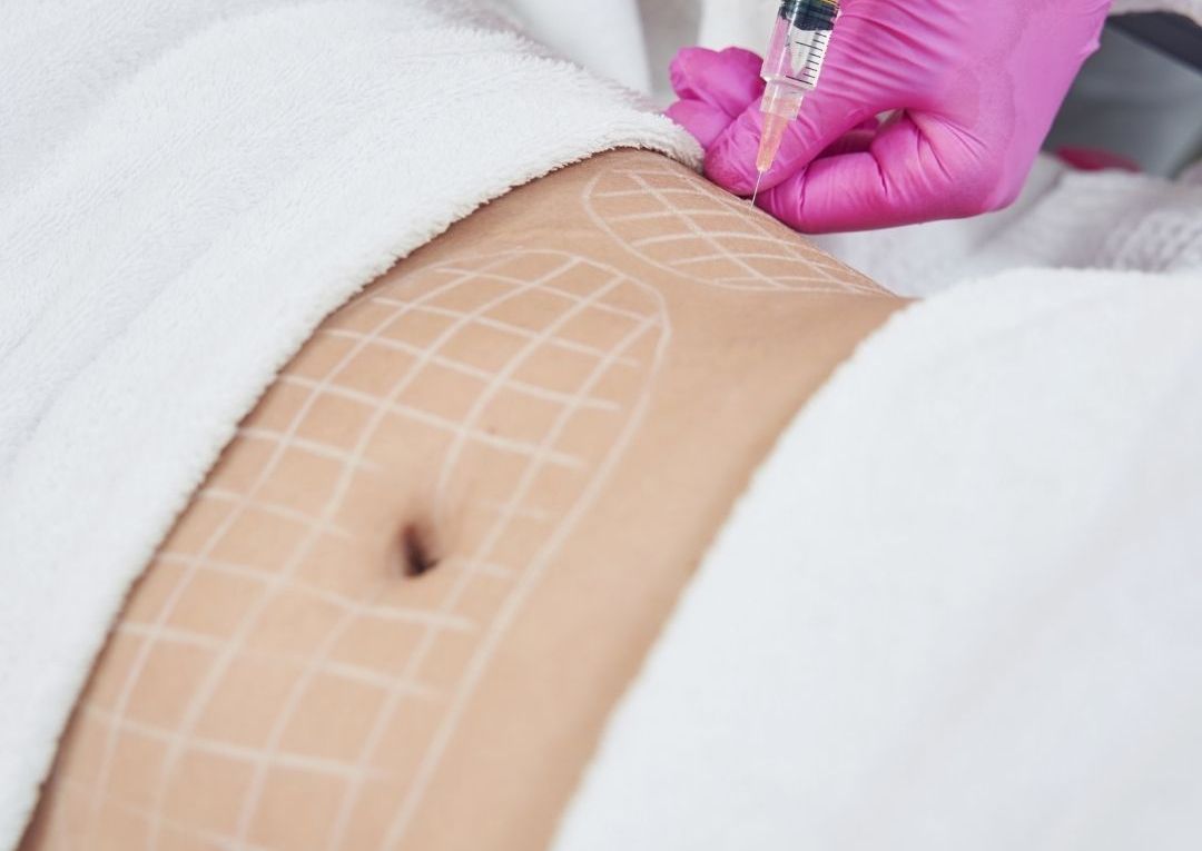 Body Contouring - Fat Dissolving