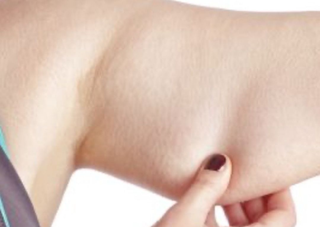 HIFU BODY - Arms (Bingo wings)