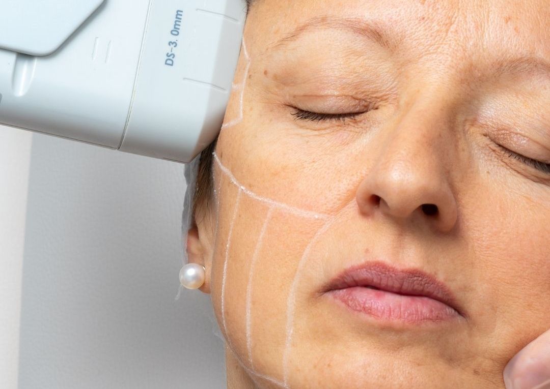 HIFU FACE - Full Face & Neck