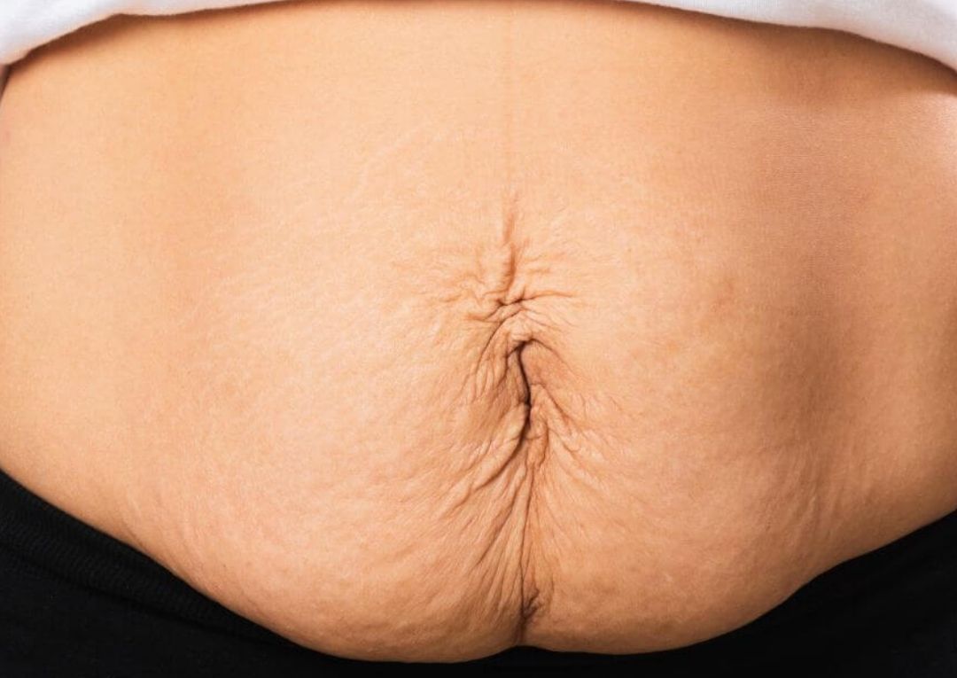 Body Contouring - Mum Tum Package