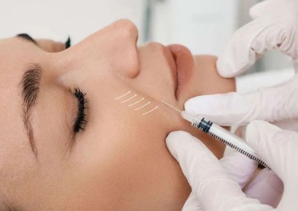 Dermal Fillers - Nasolabial Folds (Smile lines)