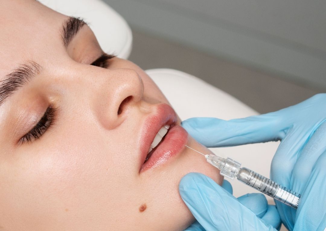 Dermal Fillers - Lips 0.5ml