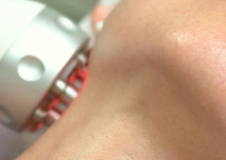 Radiofrequency Full Face & Neck