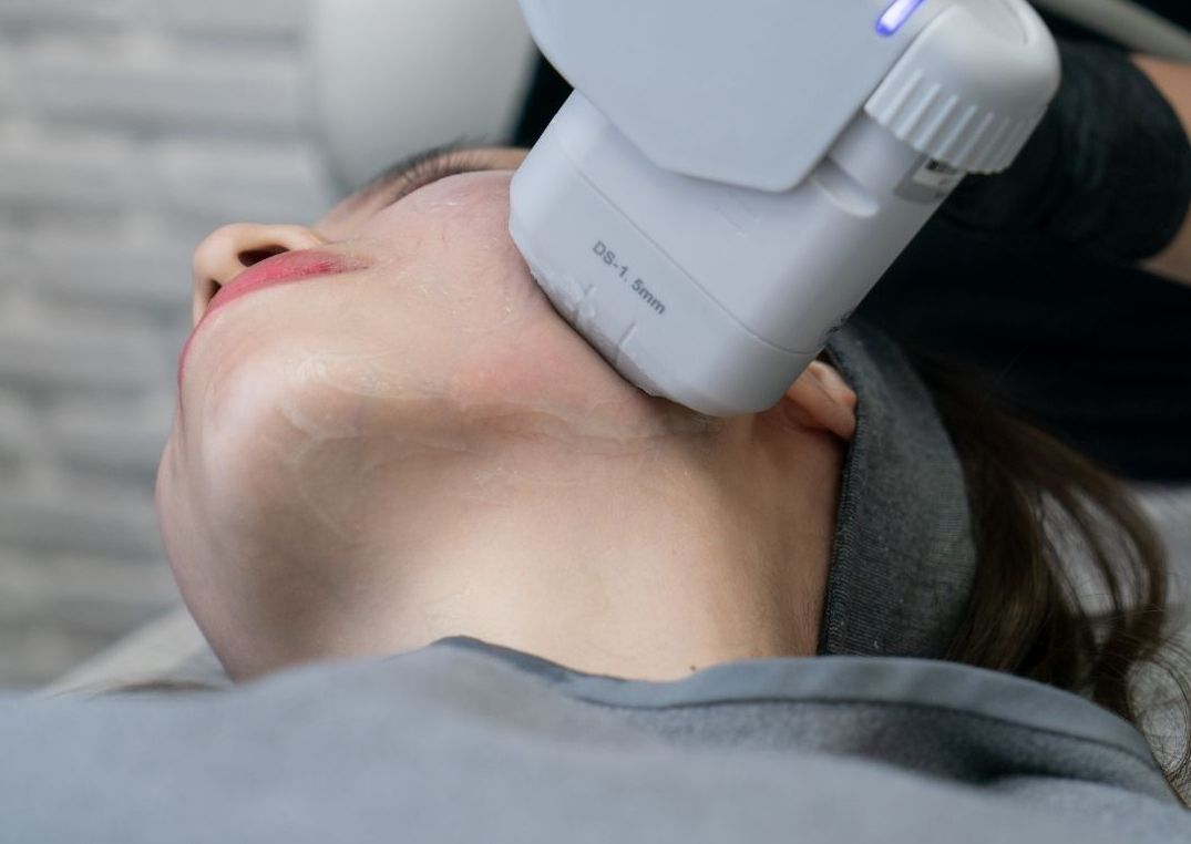 HIFU FACE - Neck only/Brow lift/Double chin