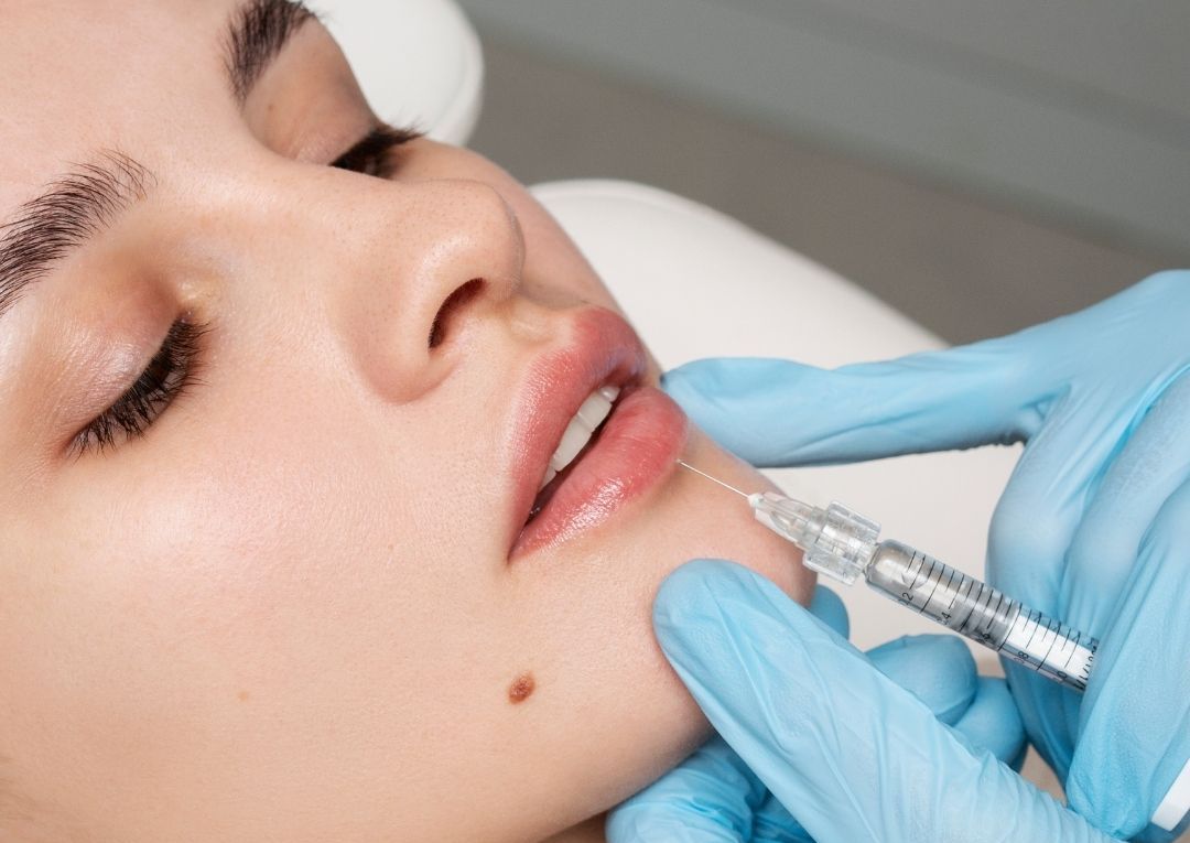 Dermal Fillers - Lips