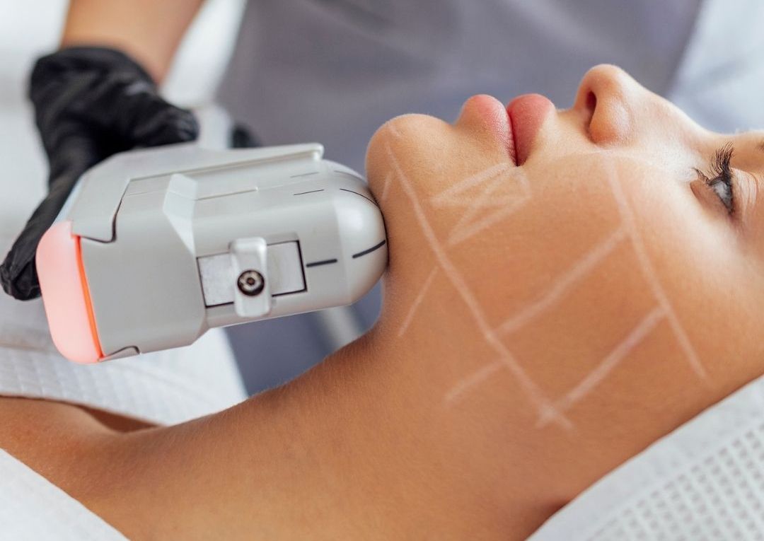 HIFU FACE - Half Face Upper/Lower