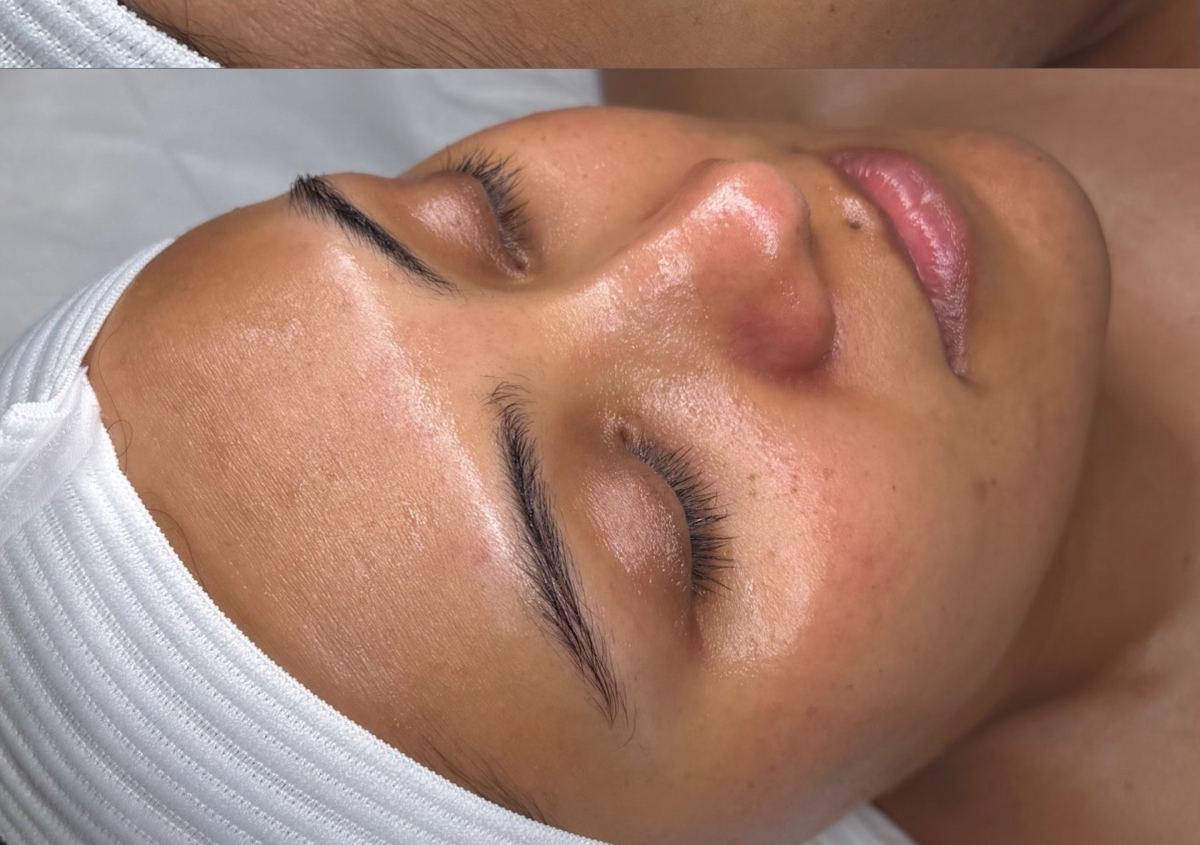Peeling químico biorepeel + Dermaplaning 