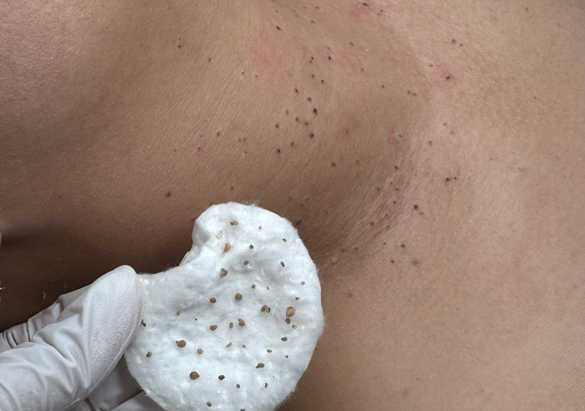 Remocion de verrugas de 6 a 10 