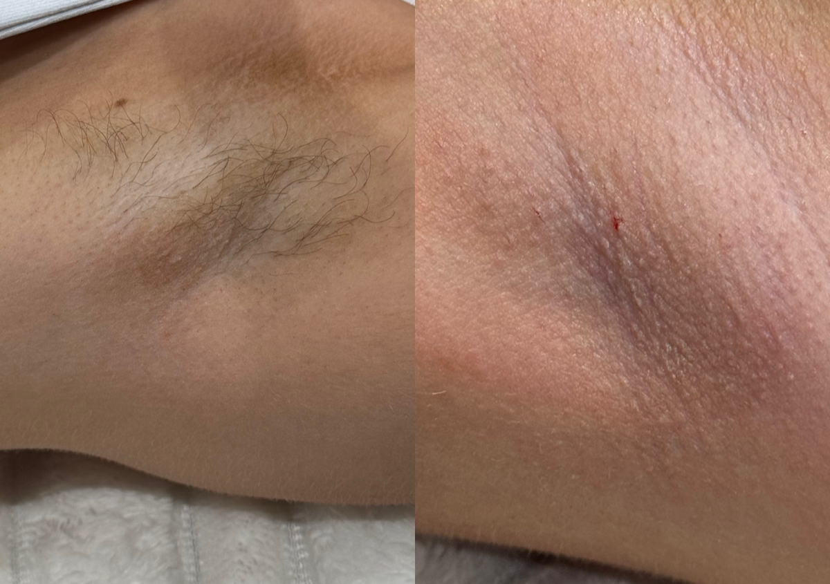 Underarm wax