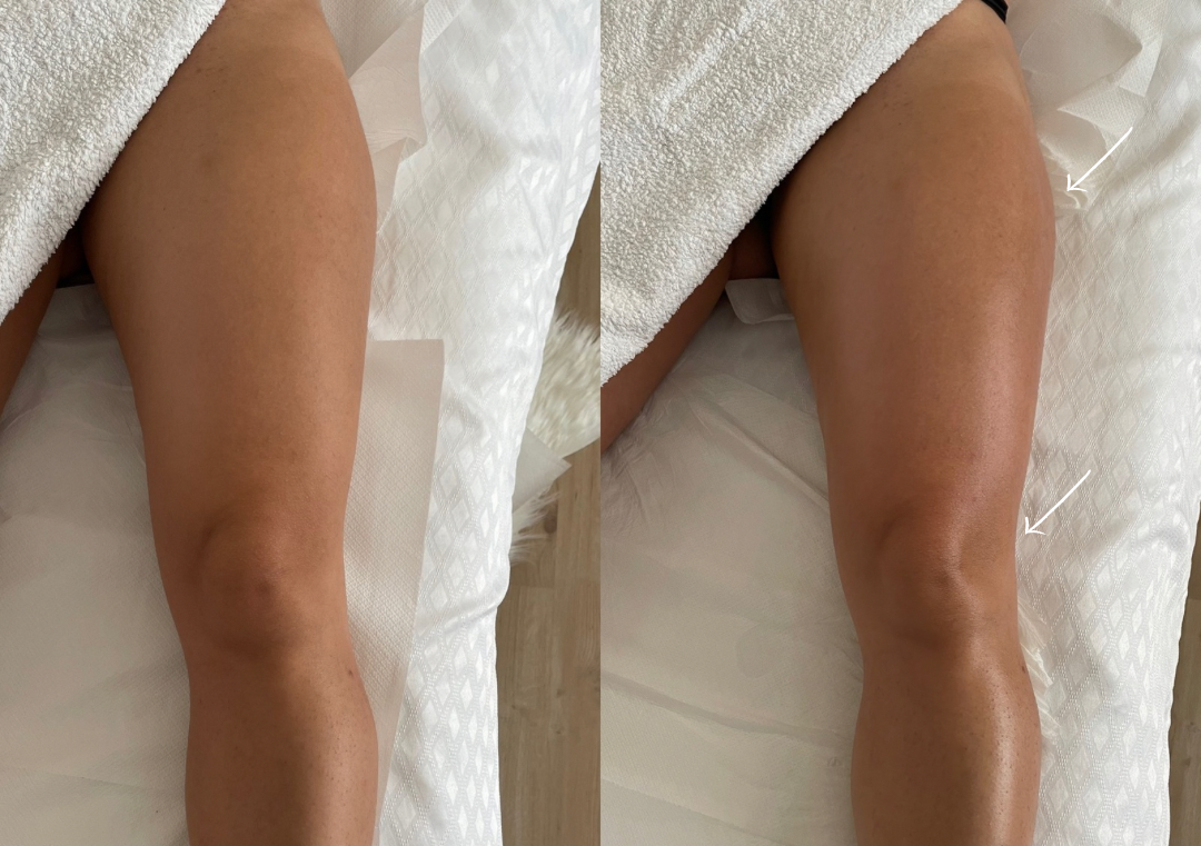 Massaggio Drenante Gambe