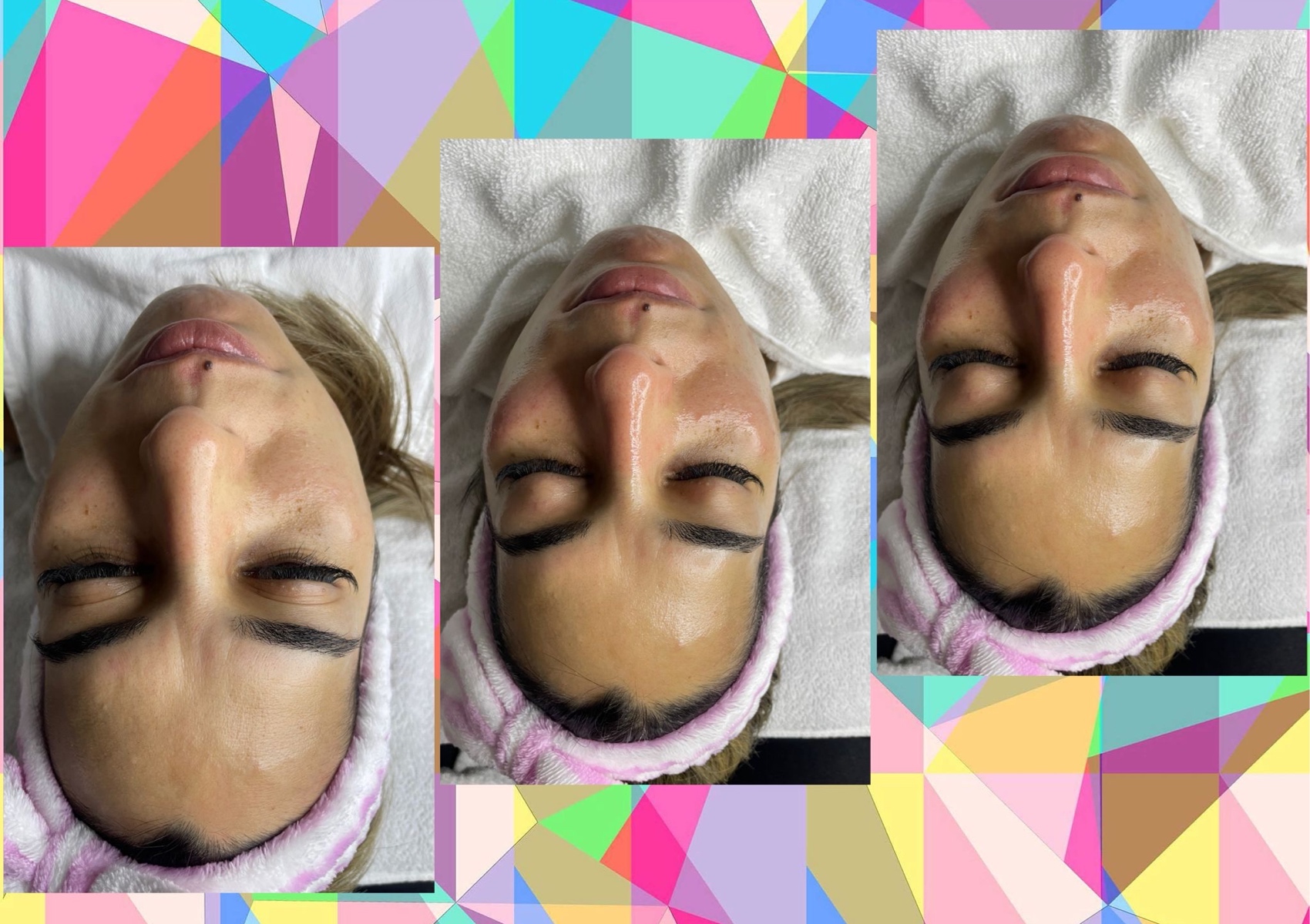 Microneedling