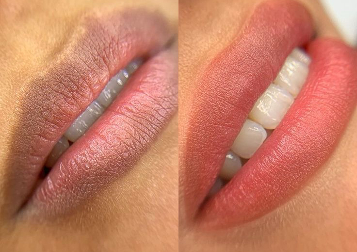 Neutralización de labios 