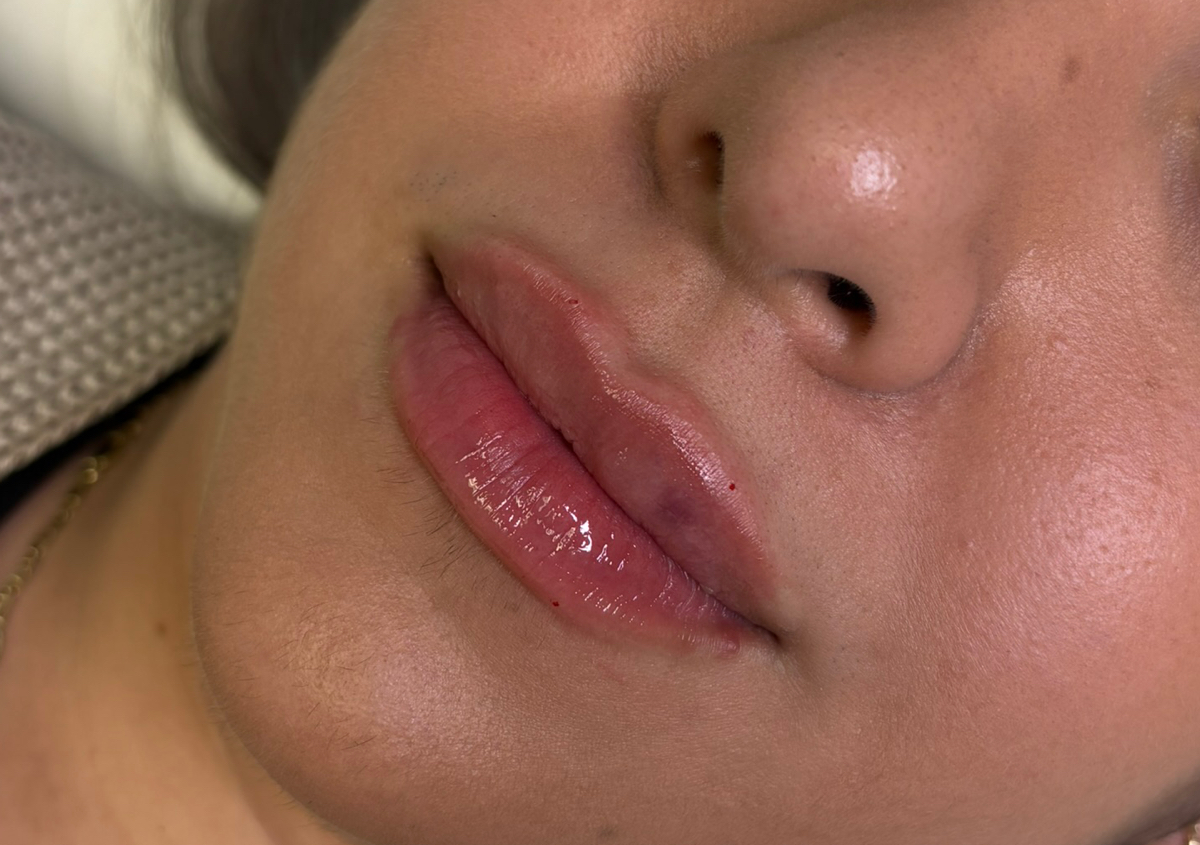 Relleno de labios 0.5 mL