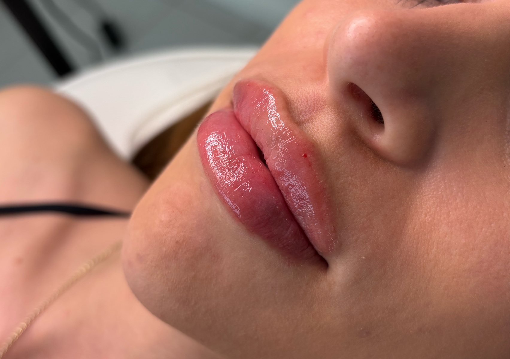 Relleno de labios 1.1 ml 