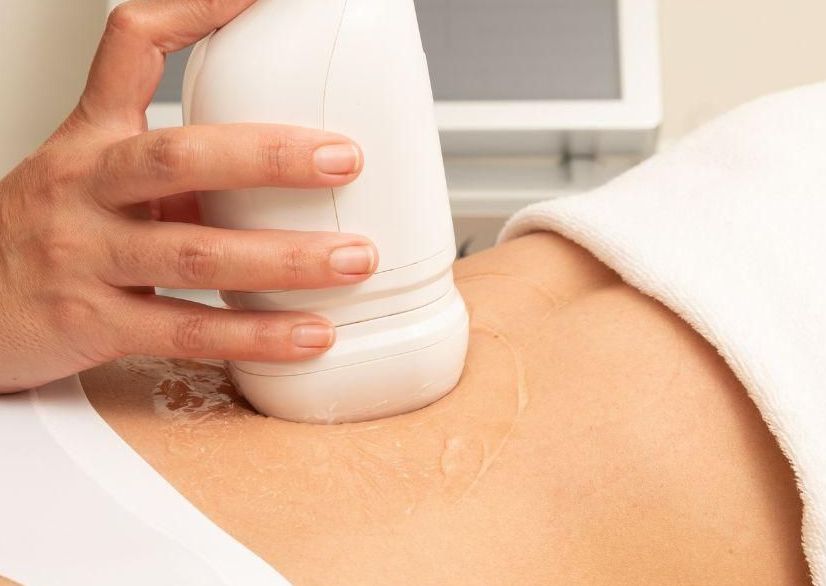 HIFU 25D Espalda Baja