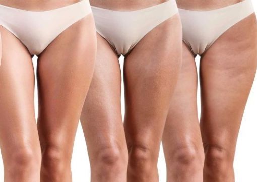 HIFU 25D Entrepiernas