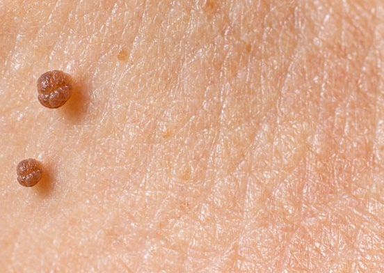 Remoción de Skin Tags (Verruga hasta 5)