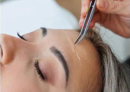 Hilos de Colágeno Tópico Absolventes