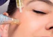 Microneedling con Exosomas