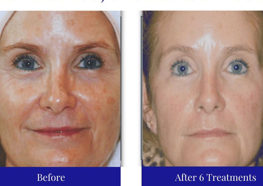 Rejuvenecimiento Dérmico / SWiCH