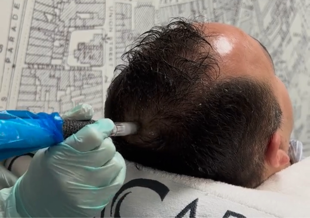 Hair Loss Microneedling 8 sessions