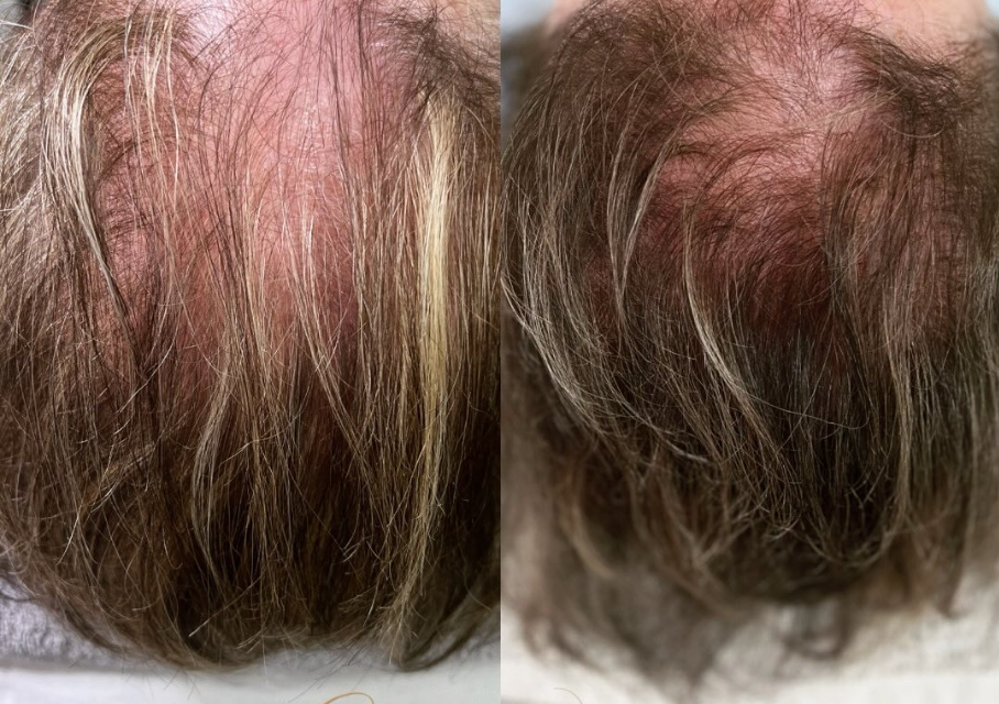 Hair Loss Mirconerdling 1 session 