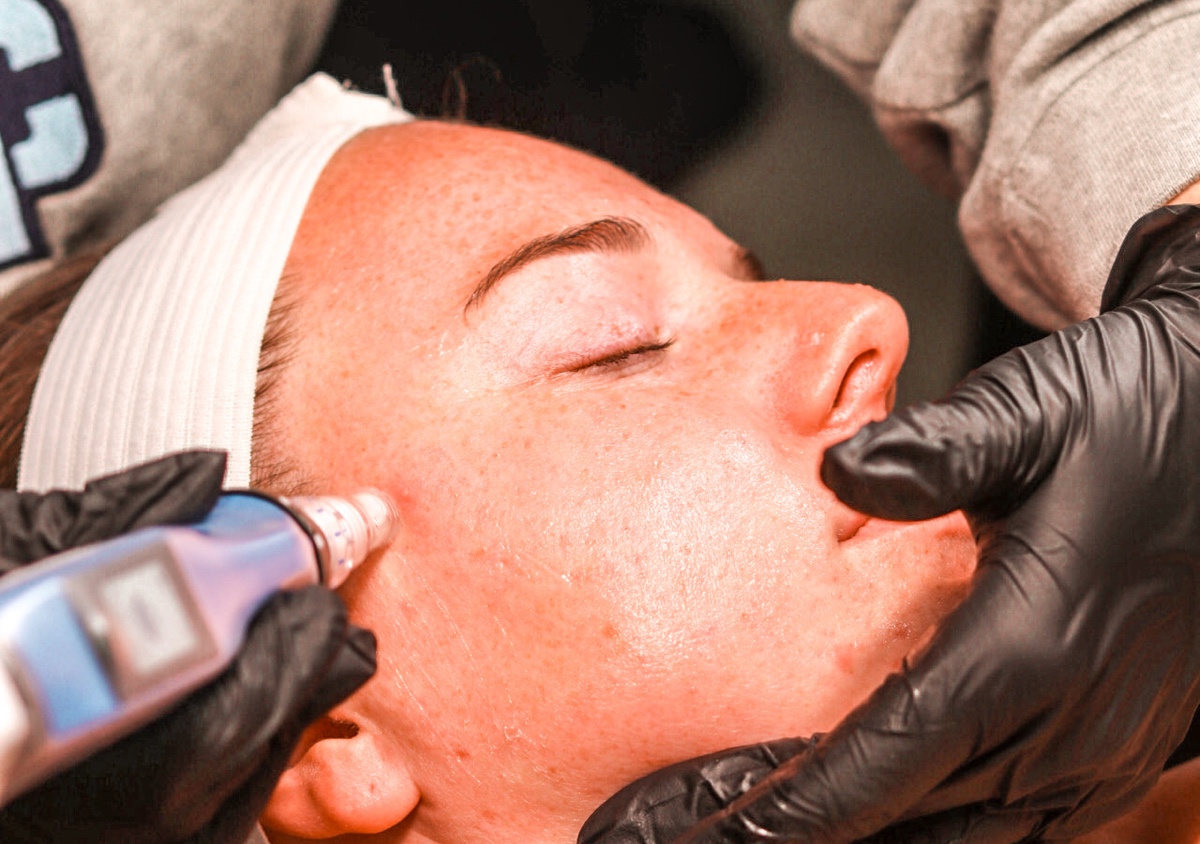 Microneedling