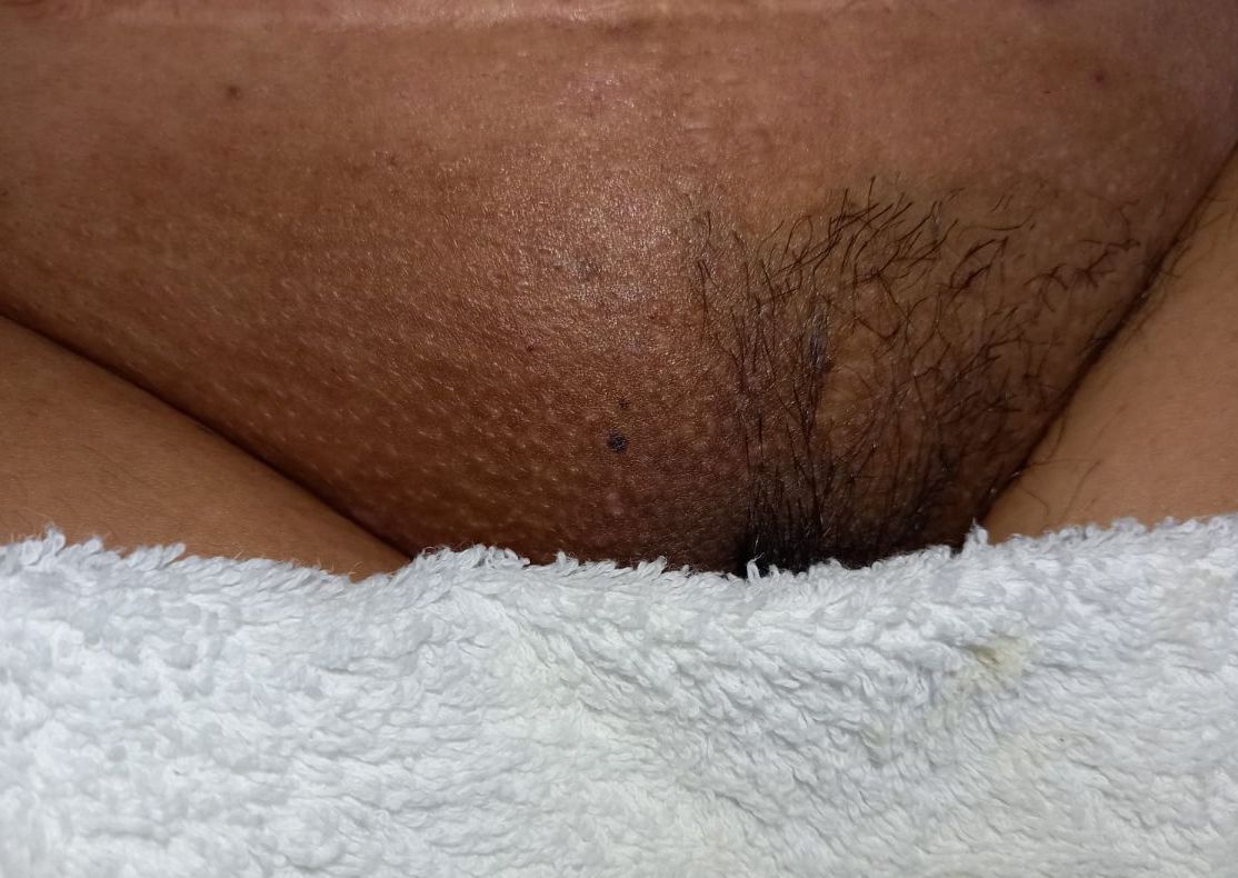 Brazilian & Vulvacial