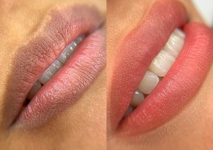 Neutralización de labios 