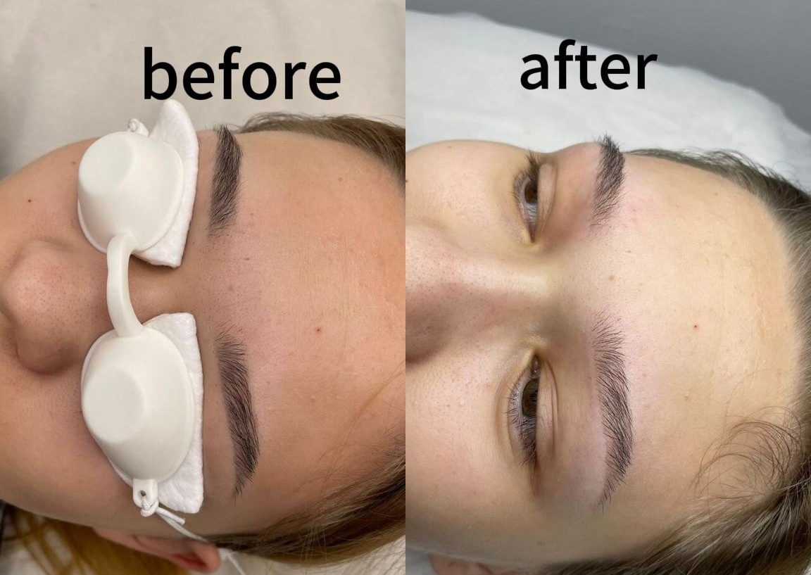 Combo láser removal tattoo x6