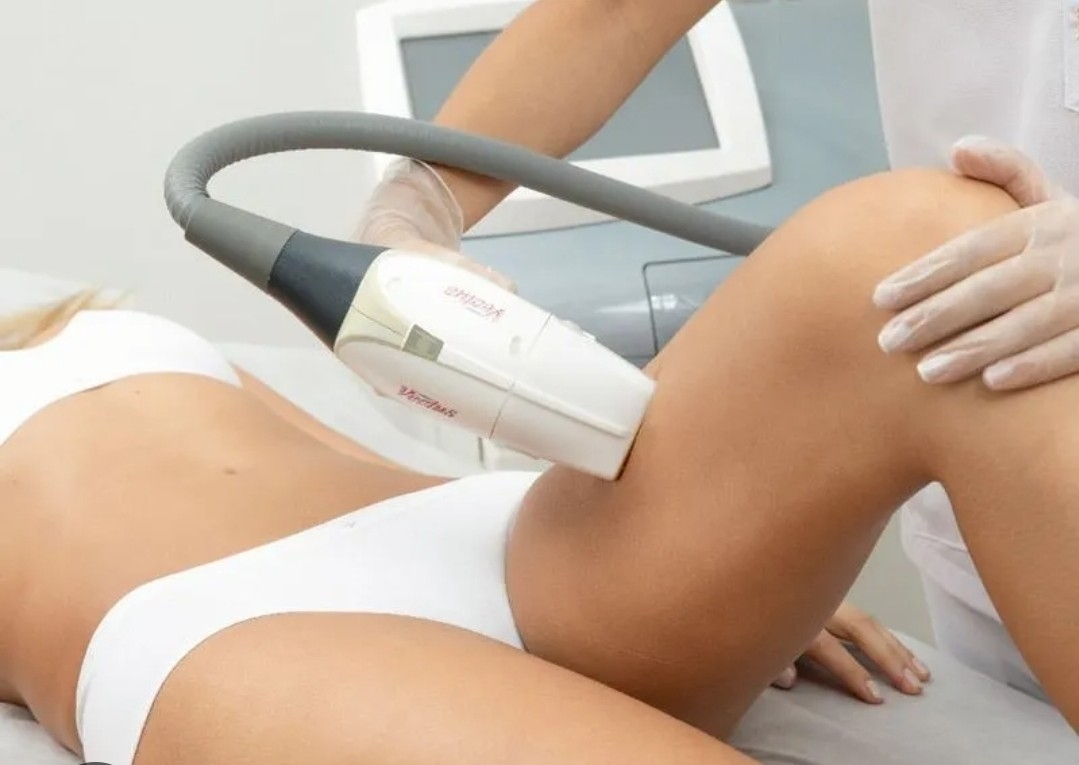 Depilación laser diodo de piernas (paquete de 6 sesiones)