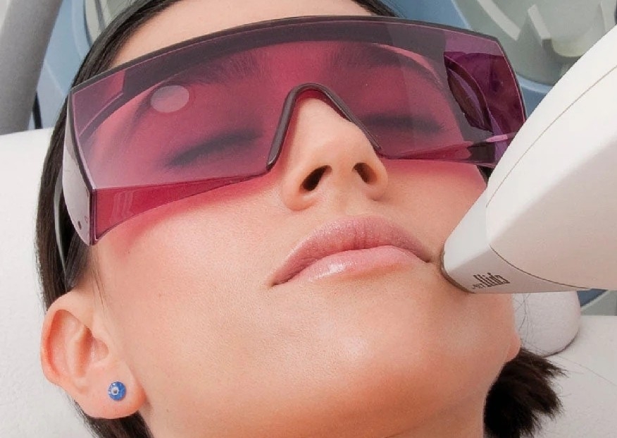 Depilación laser diodo de bozo y menton (paquete de 6 sesiones)