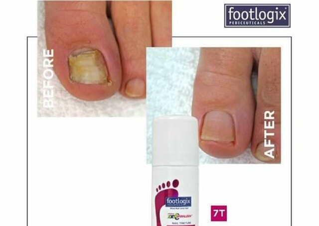 Tratamiento onicomicosis 