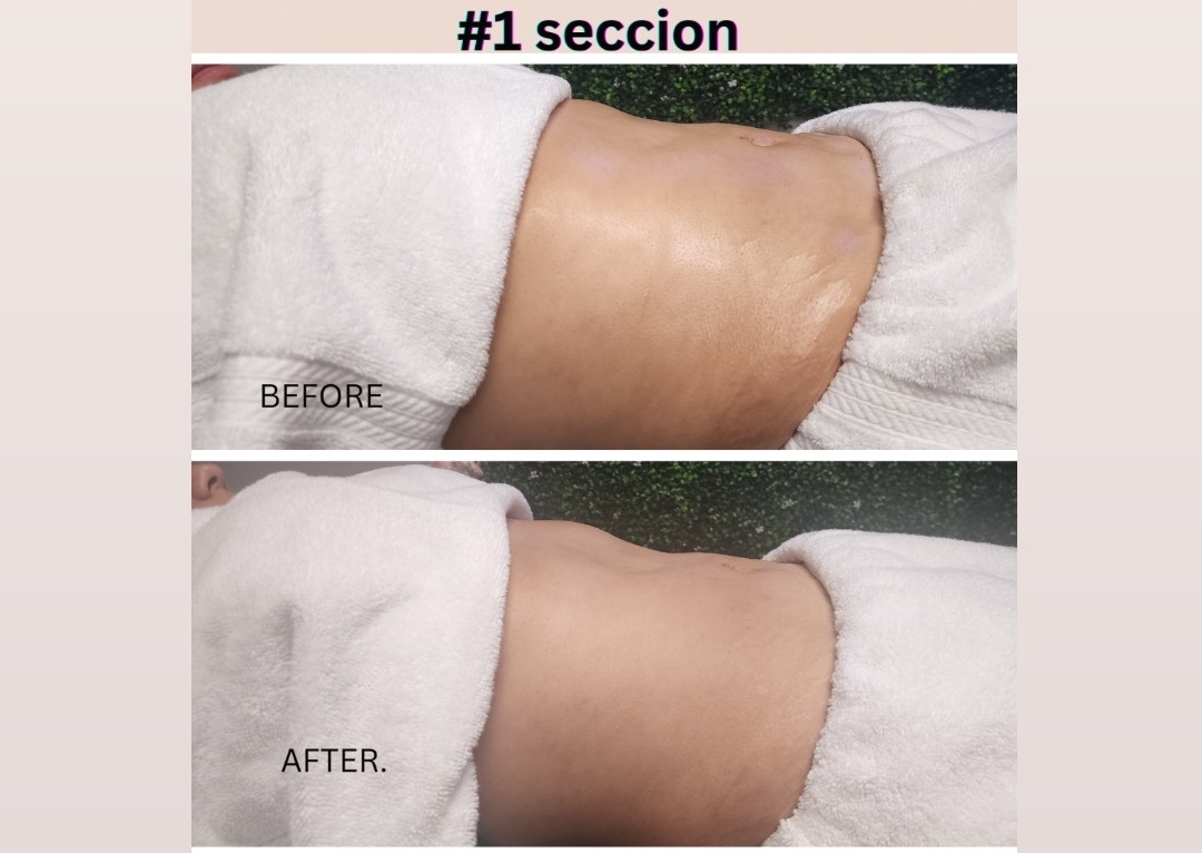 Brazilian sculpting & Lymphatic massage 