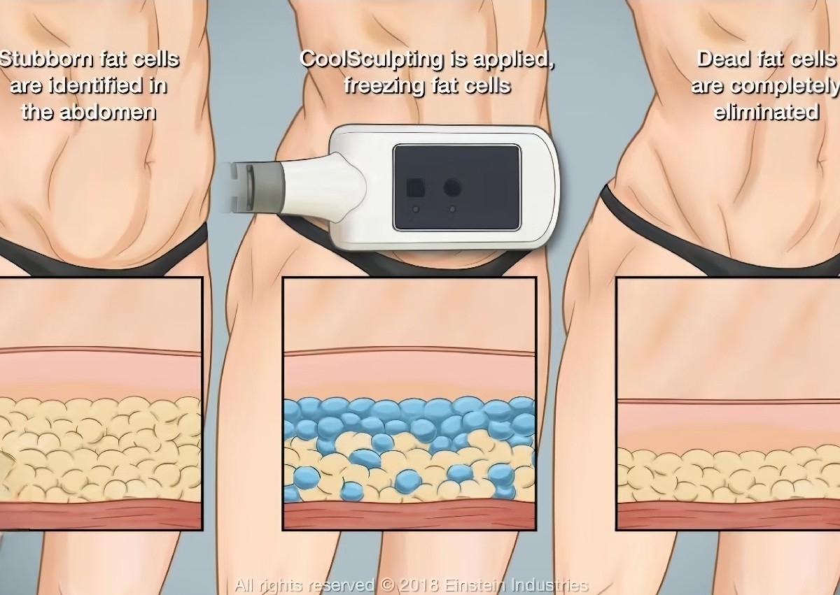 Cryolipolysis ( Package of 3) great results