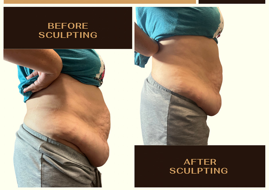 Platinum 360  (8 Sides, Back, Tummy)