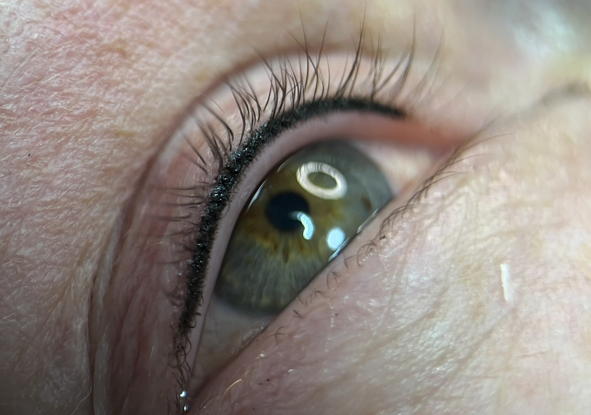 Wimpernkranzverdichtung
