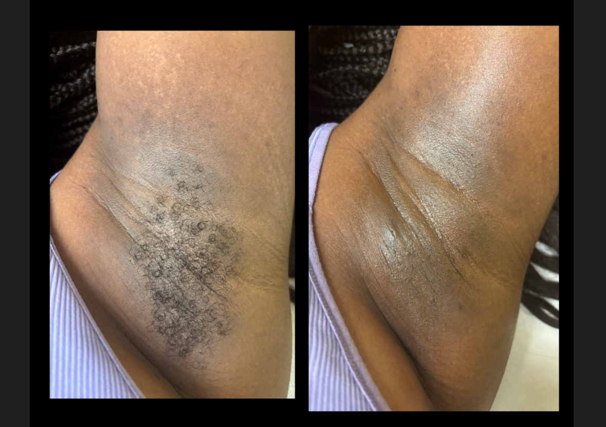 Underarm Wax