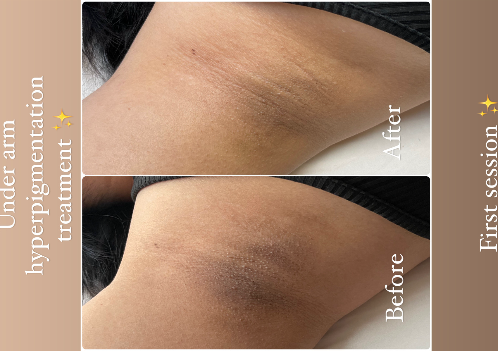  ✨BioRePeel Under arm Hyperpigmentation treatment (1 single treatment)